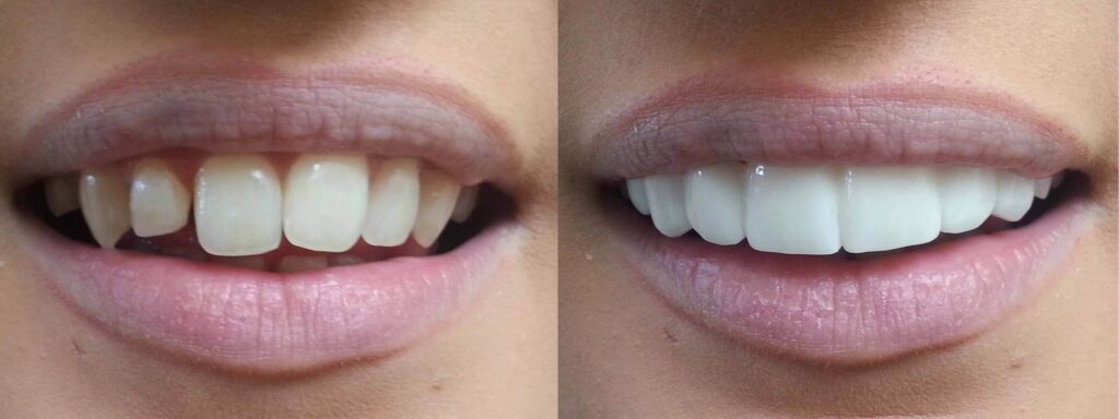 Removable Dental Veneers smile makeover