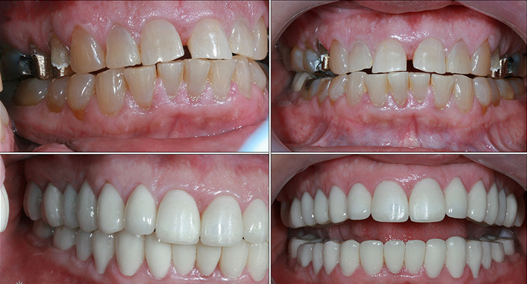 Full mouth reconstruction in Ikeja and Victoria Island, Lagos