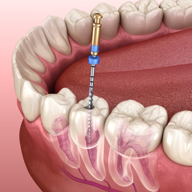 affordable root canal therapy in Lagos