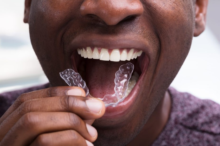 Get affordable Invisalign in Ikeja Lagos