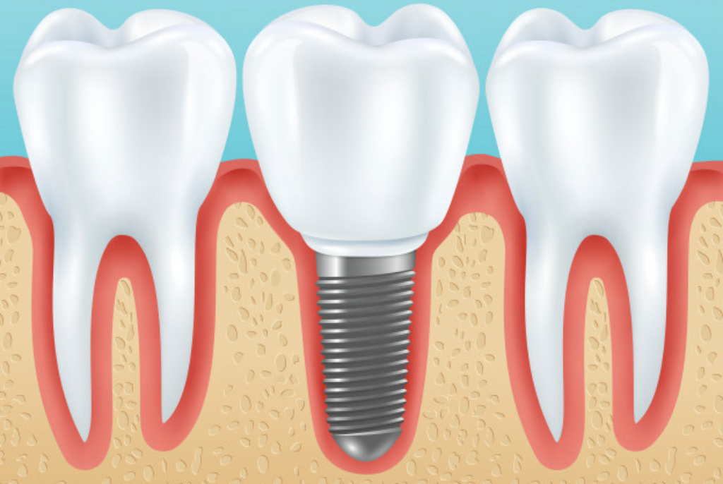 choice dental implants