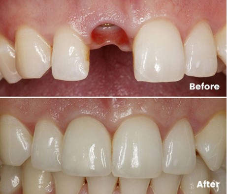 dental implant in VI lagos