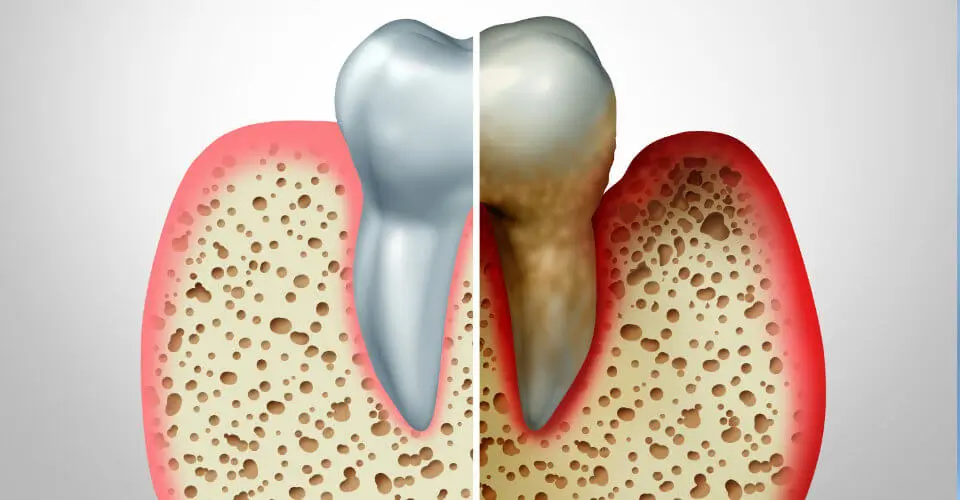 gum-disease-prevention and treatment in lagos