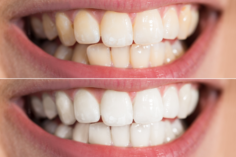 professional-teeth-whitening-before-after
