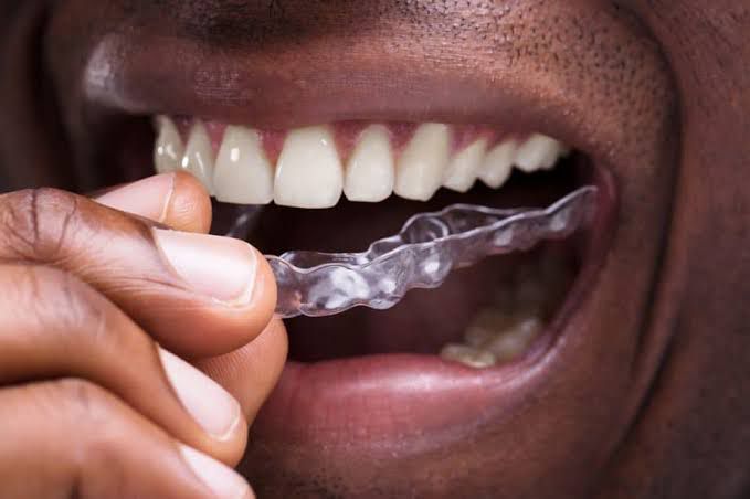 Get Invisalign in Victoria Island