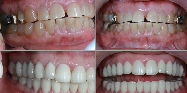 Full mouth reconstruction in Ikeja and Victoria Island, Lagos