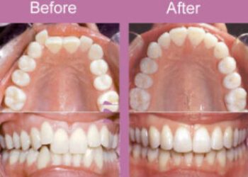 affordable teeth alignment in ikeja and victoria island
