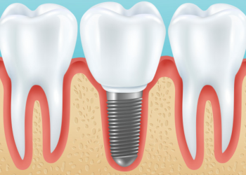 choice dental implants