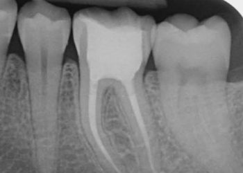root canal treatment lagos