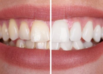 whitening-before-after
